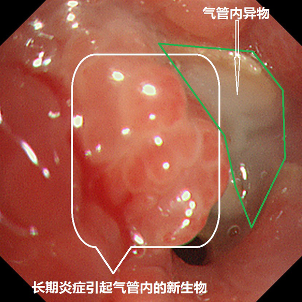 两年沉疴一朝解 支气管镜显神通